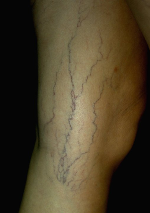 Sclerotherapy is a medical procedure used to remove and eliminate spider 
